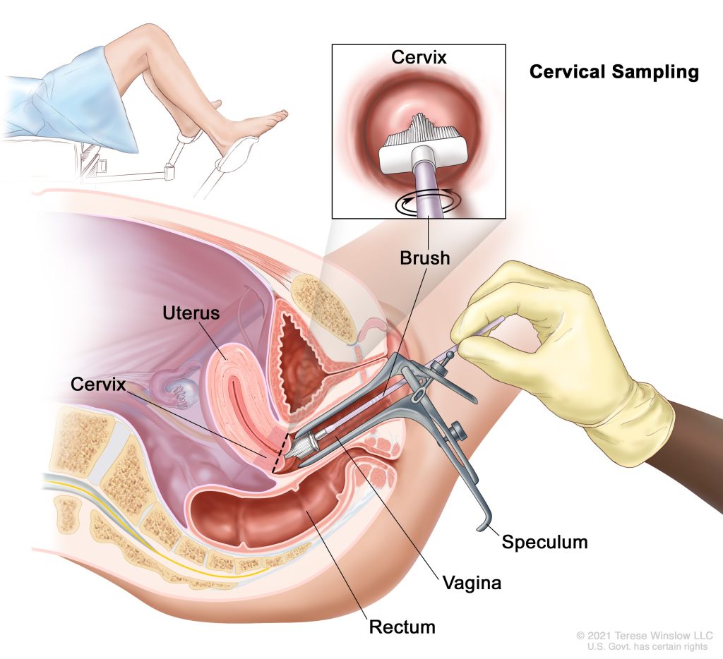 Cervical Cancer Screening: Revolutionizing Access with Self-Collection HPV Testing