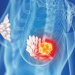 How Artificial Intelligence is Transforming Breast Cancer Detection at Bayhealth Breast Cancer Detection at Bayhealth