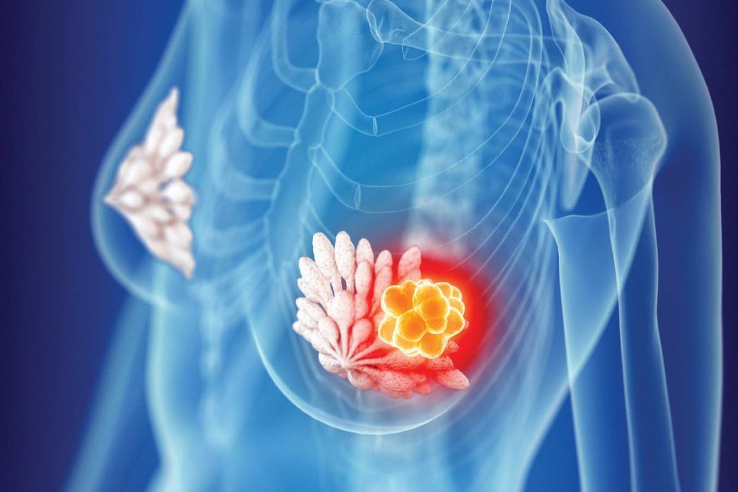 Breast Cancer Detection at Bayhealth