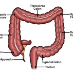 Colon Cancer in Young Adults colon cancer in young adults