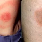 Tick Bite Prevention: Protect Yourself from Lyme Disease This Summer Lyme Disease This Summer