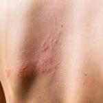 Ways to Treat & Prevent Tingles from Shingles Ways to Treat & Prevent Tingles