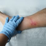 Why You Shouldn’t Ignore a Wound That Isn’t Healing Wound That Isn’t Healing