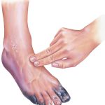 Peripheral Arterial Disease Peripheral Arterial Disease