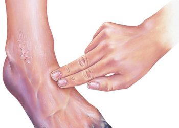 Peripheral Arterial Disease