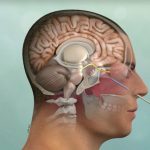 Can Brain Surgery Be Minimally Invasive and Maximally Effective? Can Brain Surgery Be Minimally Invasive