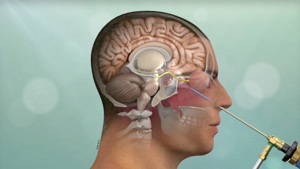 Can Brain Surgery Be Minimally Invasive Can Brain Surgery Be Minimally Invasive