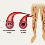 Peripheral Arterial Disease Peripheral Arterial Disease