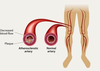 Peripheral Arterial Disease