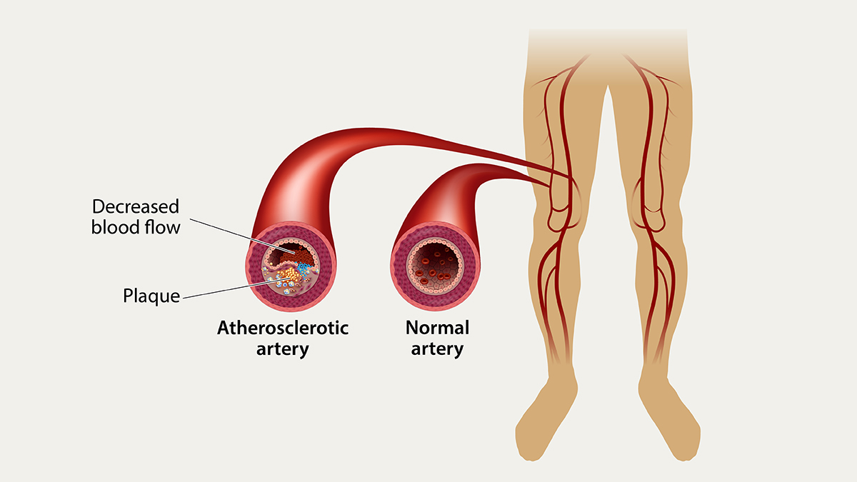 Peripheral Arterial Disease Peripheral Arterial Disease