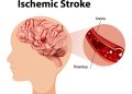 Stroke Prevention and Treatment