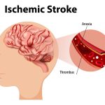 Stroke Prevention and Treatment Stroke Prevention and Treatment