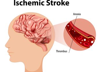 Stroke Prevention and Treatment