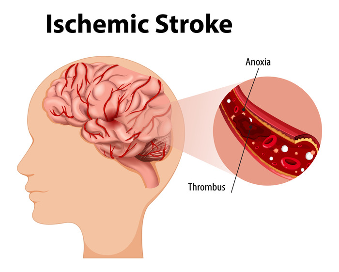Stroke Prevention and Treatment