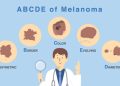 The ABCDEs of Skin Cancer