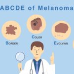 The ABCDEs of Skin Cancer The ABCDEs of Skin Cancer