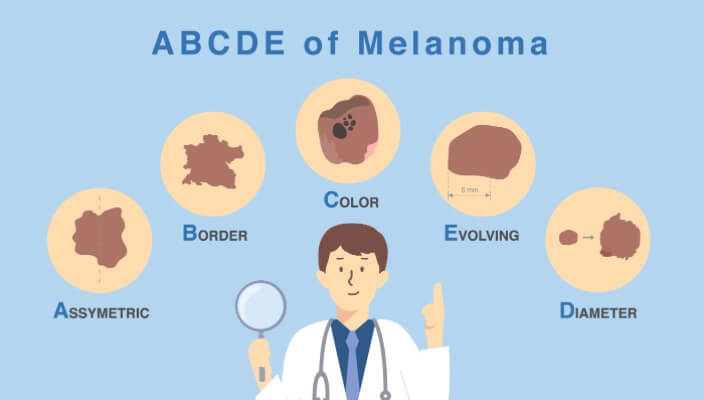 The ABCDEs of Skin Cancer The ABCDEs of Skin Cancer