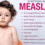 Early Signs of Measles in Kids Early Signs of Measles in Kids