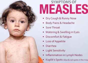Early Signs of Measles in Kids