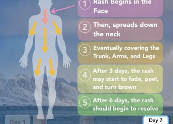 How Measles Symptoms Progress