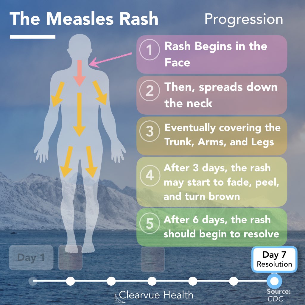 How Measles Symptoms Progress