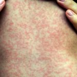 Measles Rash: What to Expect Measles Rash