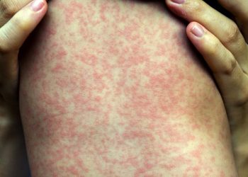 Measles Rash