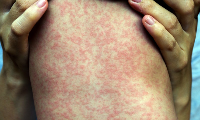 Measles Rash