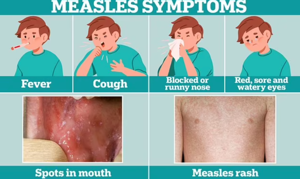 Measles or Just a Cold