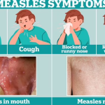 Measles or Just a Cold? Measles or Just a Cold
