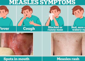 Measles or Just a Cold