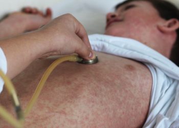 When to See a Doctor for Measles