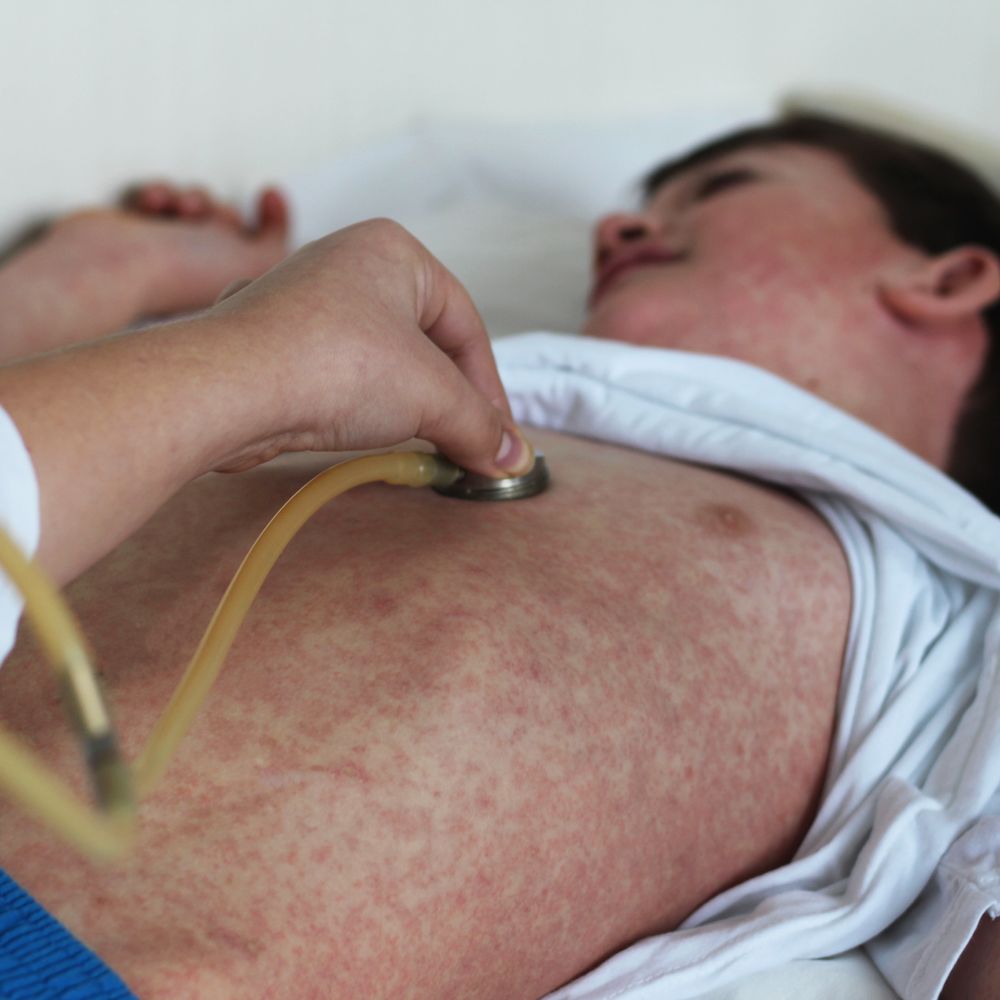 When to See a Doctor for Measles